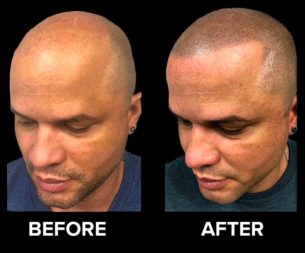 Before/After image of a man who received scalp micro pigmentation for alopecia