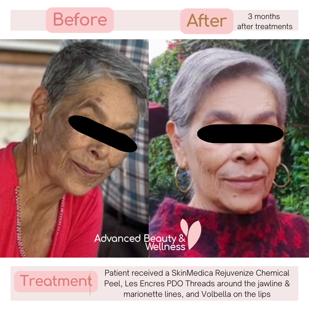 Patient received a SkinMedica Rejuvenize Chemical Peel and Les Encres PDO Threads around the jawline _ marionette lines (1).png