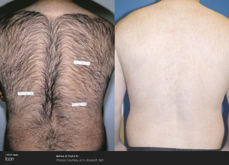 ICON-GALLERY-HAIR-REMOVAL-6.jpg