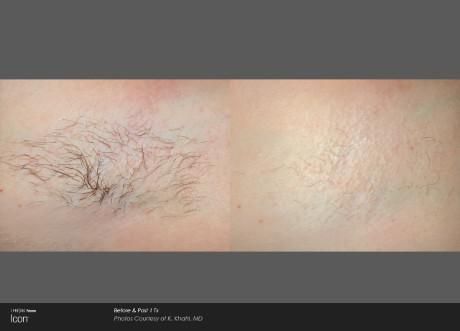 ICON-GALLERY-HAIR-REMOVAL-4.jpg