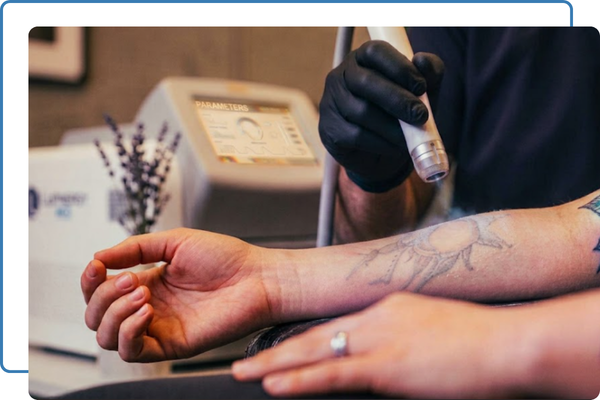 tattoo being removed on forearm