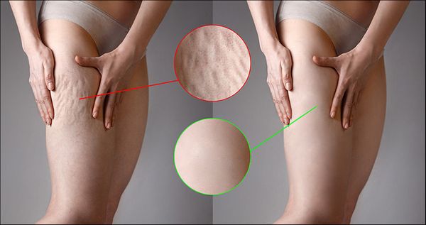 how-to-get-rid-of-cellulite.jpg