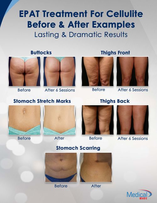 Shockwave Cellulite-BEFORE-AFTER.jpg