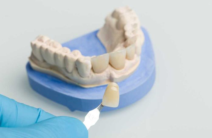 dentist displaying veneers on dental mold