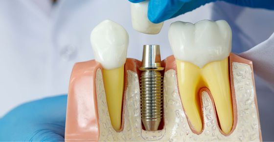 Understanding the Benefits of Dental Implants in Fort Myers FL.jpg