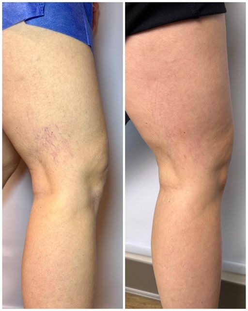 Before and After