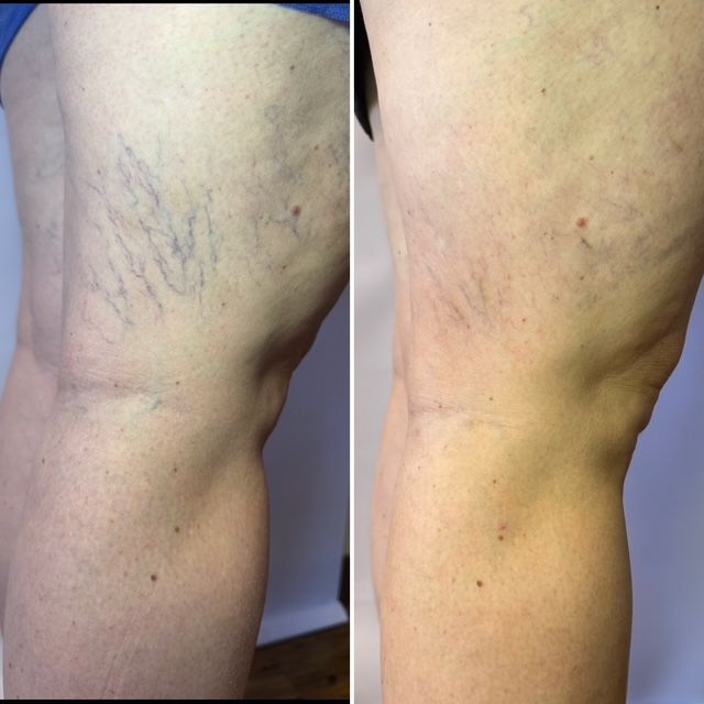 Before and After