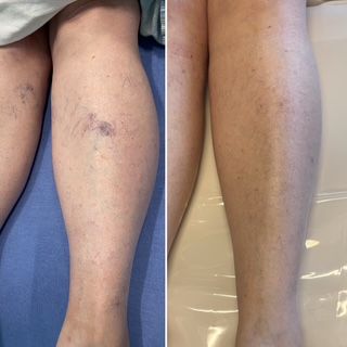 Before and After