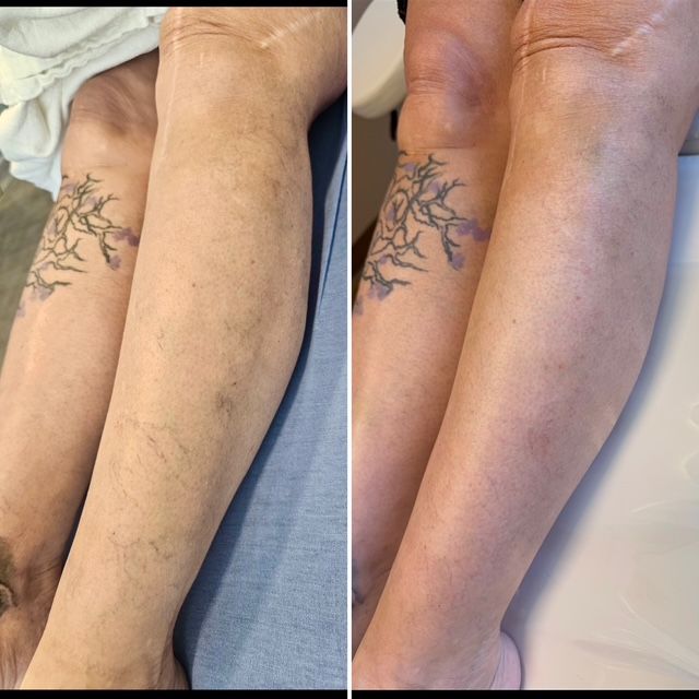 Before and After