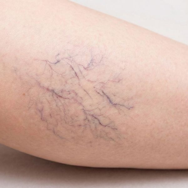 small, purplish spider veins on the side of a woman's leg
