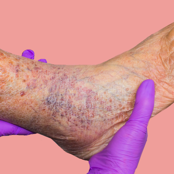 swollen ankle with varicose veins