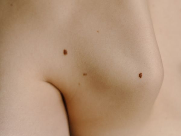 Close up of moles on a woman's shoulder blade
