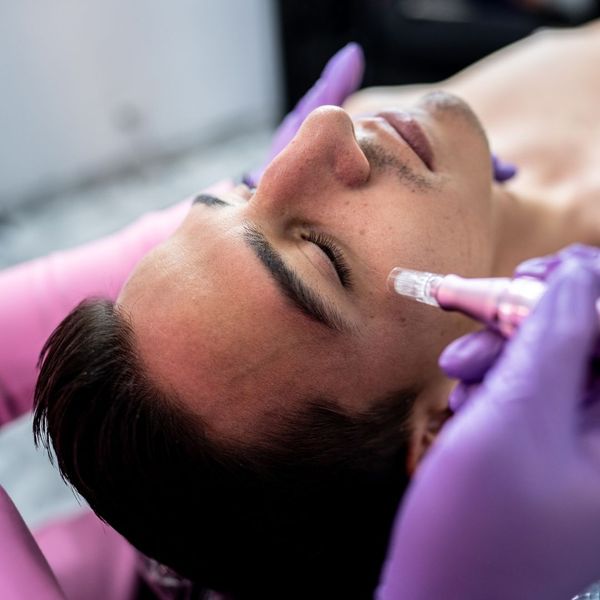 microneedling