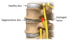 degenerative disk