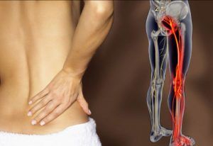 back pain sciatica