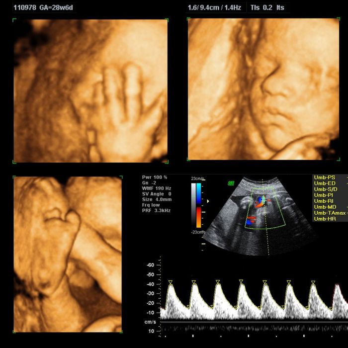  3D/4D Ultrasound