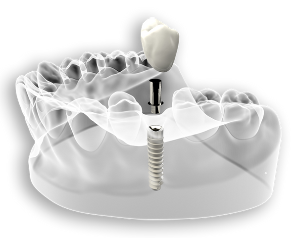 3d model of crown in teeth