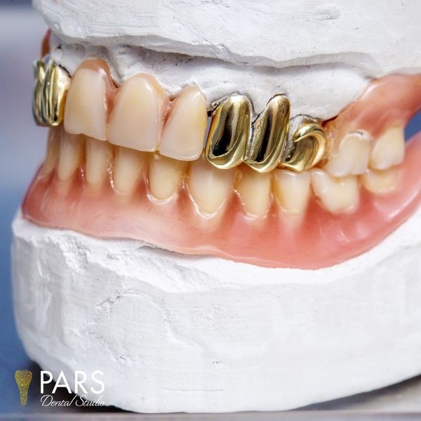 IMG 1 - Gold Crowns.jpg