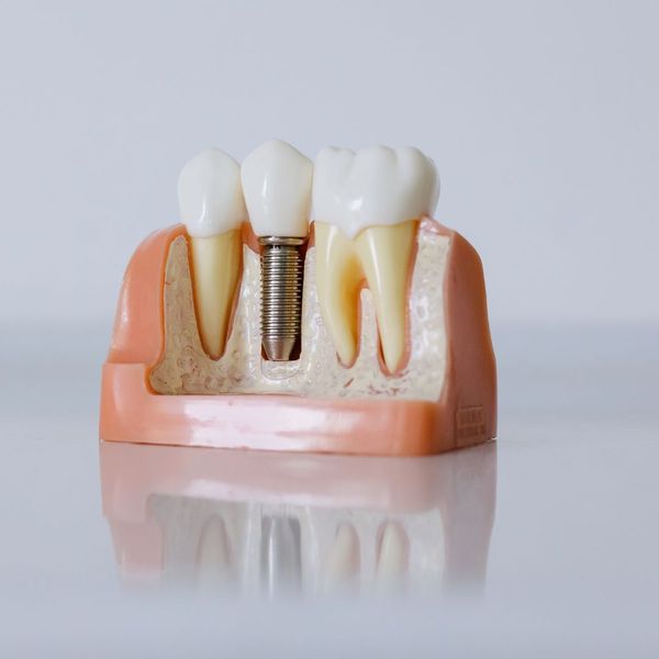 Close-Up Shot of Dental Implant Model