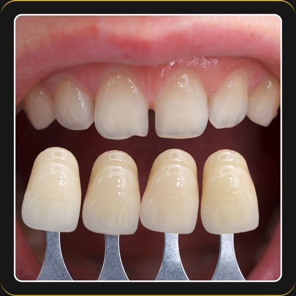 MultilayerAestheticZirconia-2.jpg