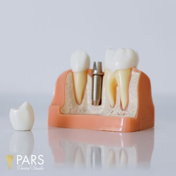 IMG 2 - Implant Restorations.jpg