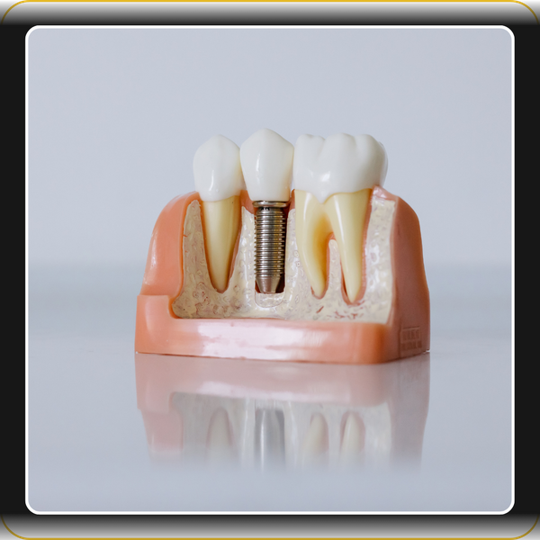 Dental Implant Dental Implant