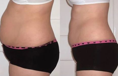 Lipo before and after 3.jpg