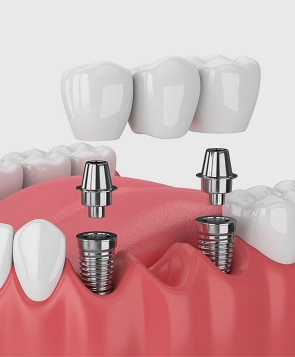 implant bridge.jpg