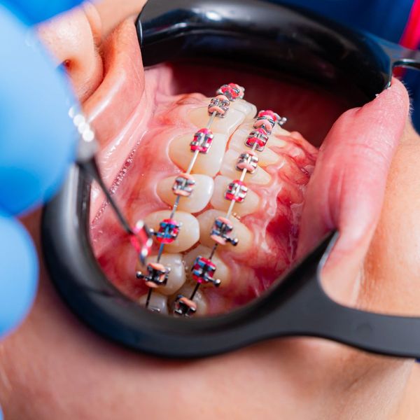 Metal braces. Metal braces.