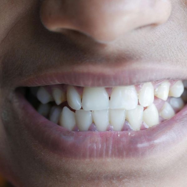 All-on-Four Dental Implants - Image 3.jpg