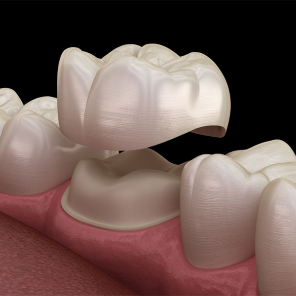 image of dental crowns