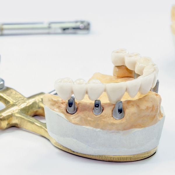 A dental model of a lower jaw with three grey implant posts, on which a white bridge of prosthetic teeth is being placed. A dental model of a lower jaw with three grey implant posts, on which a white bridge of prosthetic teeth is being placed.