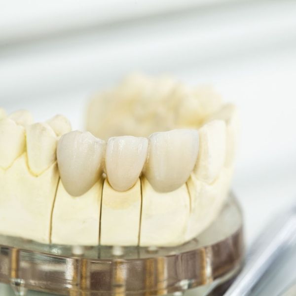 You Need a Dental Crown - Image 2 (2).jpg