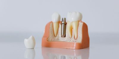 You Need a Dental Crown - Featured Image.jpg