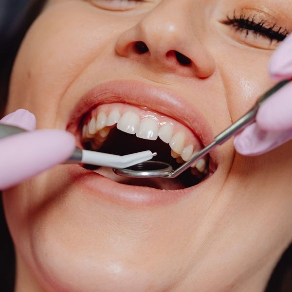 You Need a Dental Crown - Image 2.jpg