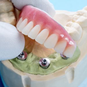 A gloved hand holds a full arch pink and white dental prosthesis, positioning it over four metal implant posts on a green model base. A gloved hand holds a full arch pink and white dental prosthesis, positioning it over four metal implant posts on a green model base.