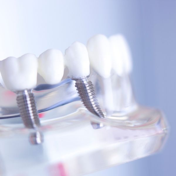 Close-up of a clear dental model showing two individual tooth implants with visible screw threads and white crowns. Close-up of a clear dental model showing two individual tooth implants with visible screw threads and white crowns.