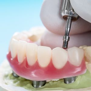 A gloved hand uses a small dental tool to screw a white prosthetic tooth into a pink gum model with four metal implant posts. A gloved hand uses a small dental tool to screw a white prosthetic tooth into a pink gum model with four metal implant posts.