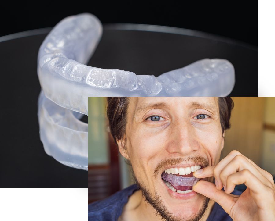 Occlusal Nightguards 1.jpg