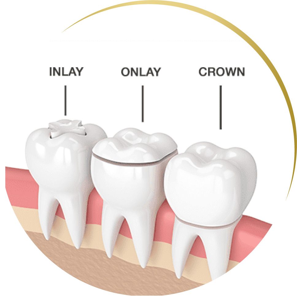 inlay, onlay, crown.jpg