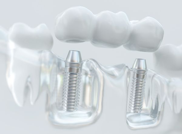 Dental Implant Bridge.jpeg