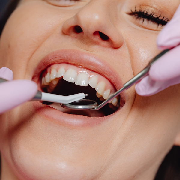 image of a dental cleaning