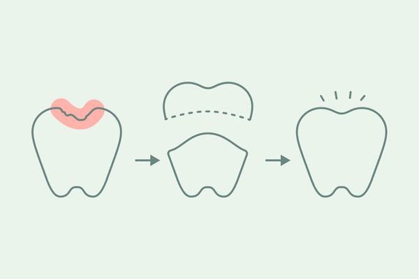 Dental Crown Process.jpg