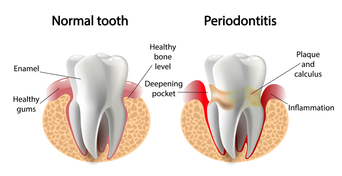 Periodontitis image.jpeg
