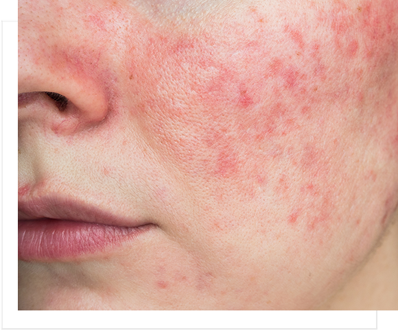 Rosacea close up 