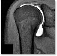 MR_shoulder_arthrogram.png