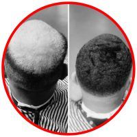 before and after of a person with a bald spot that has been covered