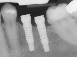 implants-x-ray.jpg