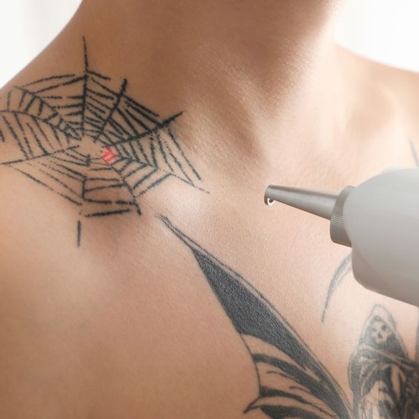 Tattoo being laser removed