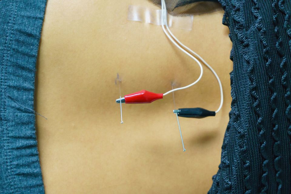 Dry Needling is an Acupuncture Technique.jpg